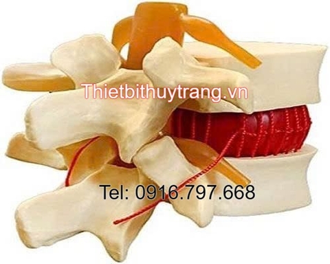 Mô Hình Thoát Vị Đĩa Đệm TVDD
