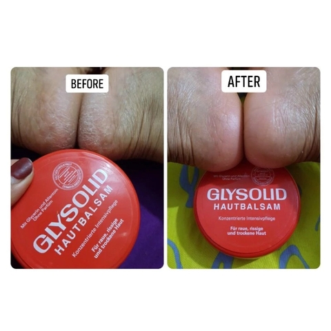 GLYSOLID - KEM NỨT GÓT CHÂN HAUTBALSAM