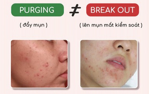 Purging là gì? Nên làm gì khi da bị purging?