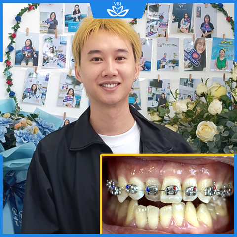 Niềng răng mắc cài kim loại