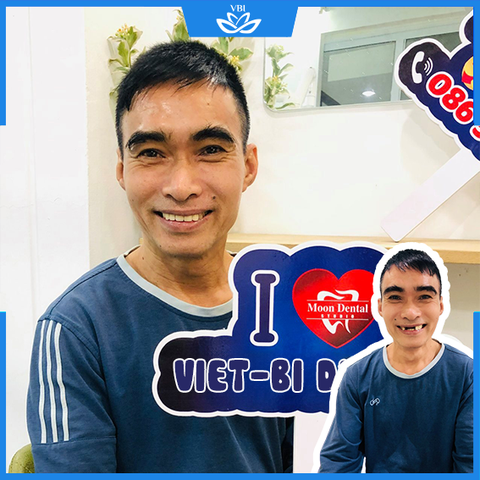 Trồng răng implant vĩnh viễn - Hotline 086 566 8066