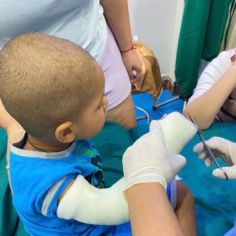 Điều trị gãy xương cho trẻ em bằng phương pháp bó bột thủy tinh