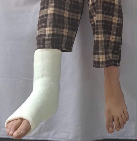 So sánh sự khác biệt giữa bột bó thủy tinh với bột bó thạch cao