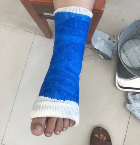 Những lưu ý chăm sóc bệnh nhân sau khi bó bột