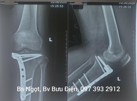 Phẫu thuật kết hợp xương mâm chày ít xâm lấn+ nội soi khớp gối