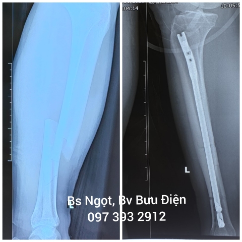 Phẫu thuật kết hợp xương bằng đinh nội tủy thân xương chày
