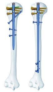 Phẫu thuật kết hợp xương đinh nội tủy thân xương cánh tay