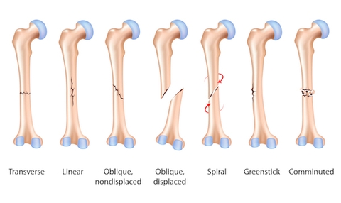 Phẫu thuật kết hợp xương bằng đinh nội tủy thân xương đùi