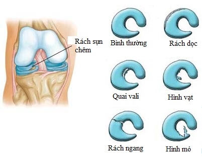 Phẫu thuật Nội soi cắt sụn chêm