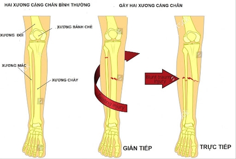 Phẫu thuật kết hợp xương bằng nẹp vis thân xương chày