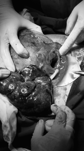 CẢNH BÁO: VỠ TỬ CUNG TRÊN BỆNH NHÂN MỔ ĐẺ CŨ