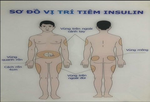 KỸ THUẬT TIÊM INSULIN