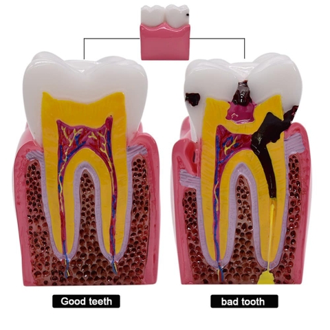 Mô hình tư vấn răng khỏe, răng sâu