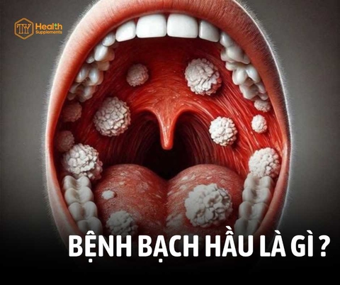 NGUYÊN NHÂN BỆNH BẠCH HẦU? TRIỆU CHỨNG NHẬN BIẾT VÀ CÁCH PHÒNG TRÁNH