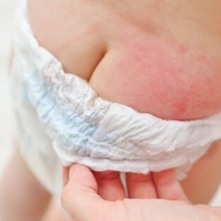 Bé bị hăm có phải do bỉm không? Hướng dẫn chăm sóc bé để ngăn ngừa hăm bỉm