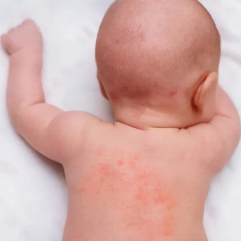 Rôm sảy là gì? Vì sao bé thường bị rôm sảy vào mùa hè?