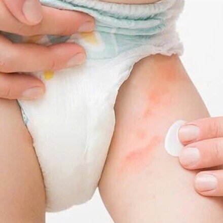 Một số vấn đề về da bé sơ sinh thường gặp phải trong tháng đầu tiên và cách vệ sinh cho bé sơ sinh đúng chuẩn