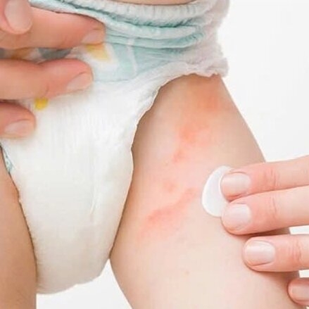 Cách phân biệt hăm bỉm do nóng và do kích ứng da