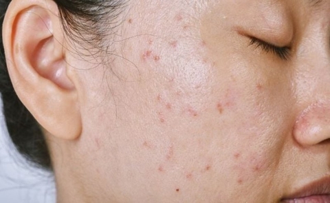 Giải đáp: Da dầu mụn nên xử lí như nào để có một làn da láng mịn?