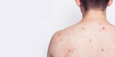 Tìm hiểu về nguyên nhân mụn lưng ở tuổi dậy thì và cách khắc phục