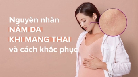 Nguyên nhân nám da khi mang thai: Sự thay đổi nội tiết và những biểu hiện tự nhiên