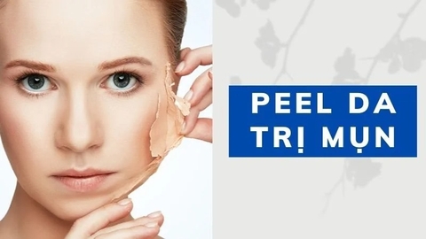 Giải đáp vấn đề peel da trị mụn có tốt không?