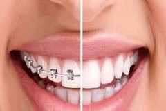Vì sao cần niềng răng