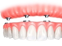 Nên sử dụng kỹ thuật cấy ghép Implant khi nào?