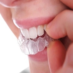 Niềng răng thẩm mỹ đẹp tự nhiên - Phòng Khám Răng Hà Nội