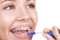 Invisalign – Niềng răng không mắc cài