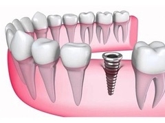 5 ưu điểm vượt trội của cấy ghép răng Implant