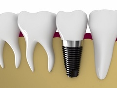 Cấu tạo của răng cấy ghép Implant