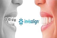 Các loại mắc cài niềng răng