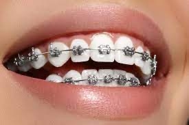 Hàm duy trì niềng răng