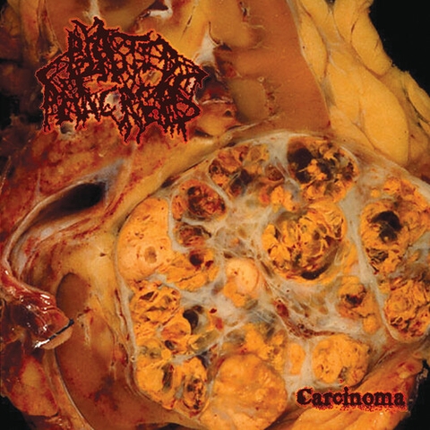 Blasted Pancreas - Carcinoma (Colored Vinyl, Red, Limited Edition)
