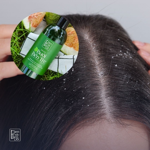 Da Đầu Nhờn Nhưng Lại Ngứa Và Có Gàu – Nên Chọn Loại Dầu Gội Nào?