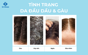 Các dấu hiệu nhận biết da đầu dầu và gàu: Khám phá cách giải quyết với Dr's Formula Anti-Oil & Anti-Dandruff Shampoo