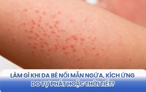 Làm gì khi da bé nổi mẩn ngứa, kích ứng do tự phát hoặc thời tiết? Chăm sóc với gel làm dịu da cho bé