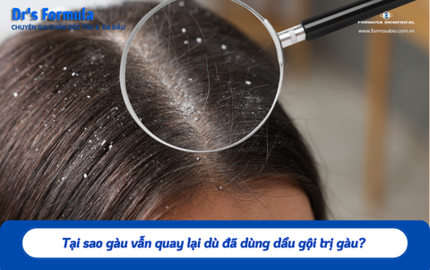 Tại sao gàu vẫn quay lại dù đã dùng dầu gội trị gàu? Sai lầm khi chọn sản phẩm và giải pháp hiệu quả