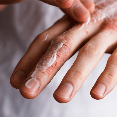 Kem bôi nấm á sừng- nấm móng-viêm da cơ địa nội địa Hàn Quốc
