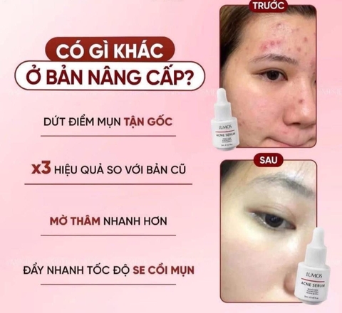 Serum Mụn Lumos Acne GC Nature USA, Lọ 5mL Giúp Ngăn Ngừa Và Làm Se Khô Nhanh Các Nốt Mụn Trên Da