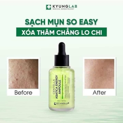 Serum KyungLab Acnes Dưỡng trắng, giảm mụn và ngừa thâm hiệu quả 50ml Bản nâng cấp 2024