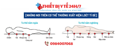 Sanyrene - Giải pháp toàn diện ngăn ngừa loét tì đè