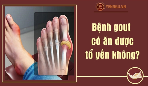 Bệnh gout có ăn được tổ yến không?