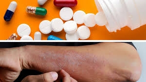 Kháng viêm, kháng dị ứng