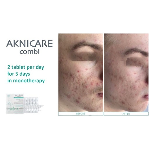 Viên Uống Hỗ Trợ Giảm Mụn Aknicare Combi