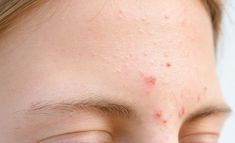 10 Nguyên Nhân Chính Tác Động Lên Làn Da Của Bạn Trở Nên Thiếu Thẫm Mỹ