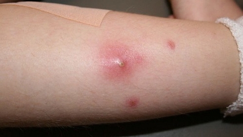 Cách Sử Dụng Cây Long Nha Thảo Để Trị Mụn Nhọt