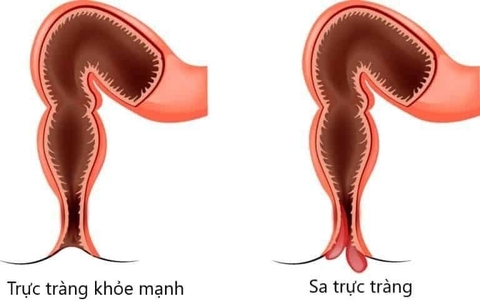 Sa Thực Tràng Và Cách Chữa Trị Từ Vị Thuốc Cỏ Nến Trong Y Học Cổ Truyền