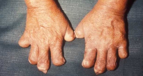 Ngăn Chặn Bệnh Hủi Nhờ Hạt Cây Đại Phong Tử